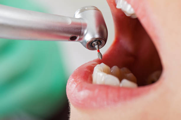 Best Lost Filling or Crown Replacement in Princeton, KY